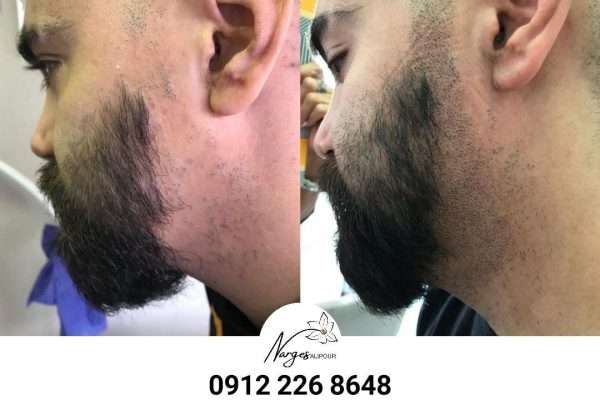 میکروپیگمنتیشن ریش