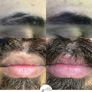 میکروپیگمنتیشن